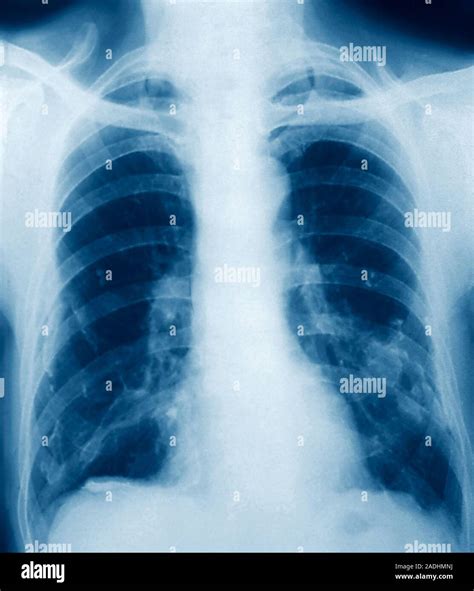 Pleural calcification. Coloured frontal X-ray of the lungs of a patient ...