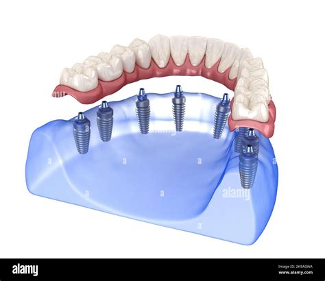 Maxillary and Mandibular prosthesis with gum All on 8 system supported by implants. Medically ...