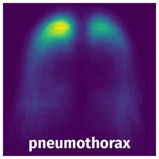 SIIM-ACR Pneumothorax Segmentation 2019 - Dataset Ninja