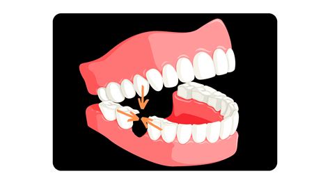 Image result for Problems After Tooth Extraction