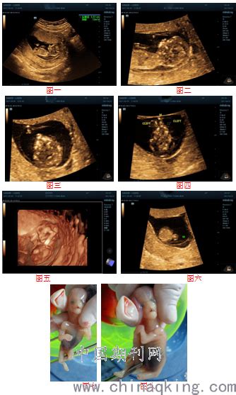 产前超声诊断孕12周胎儿双侧唇腭裂1例--中国期刊网