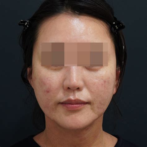 【又吉院長 ベイザー脂肪吸引アキーセル＋マイクロCRF＋ゴルゴ線剥離】40代女性 | 銀座シンシアスタッフ☆みんなのキレイのお手伝い☆