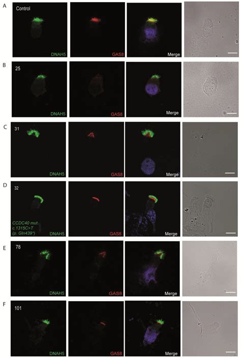 Diagnostic Role of Immunofluorescence Analysis in Primary Ciliary ...