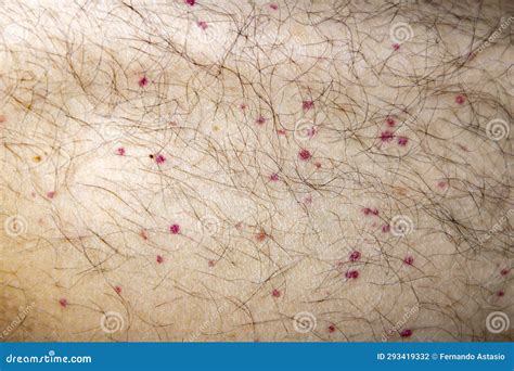 Vasculitis. Vasculitis in Legs. Small Red or Purple Spots. Rare Disease. Stock Photo - Image of ...