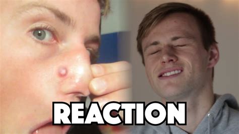 Image result for Worst Exploding Pimple