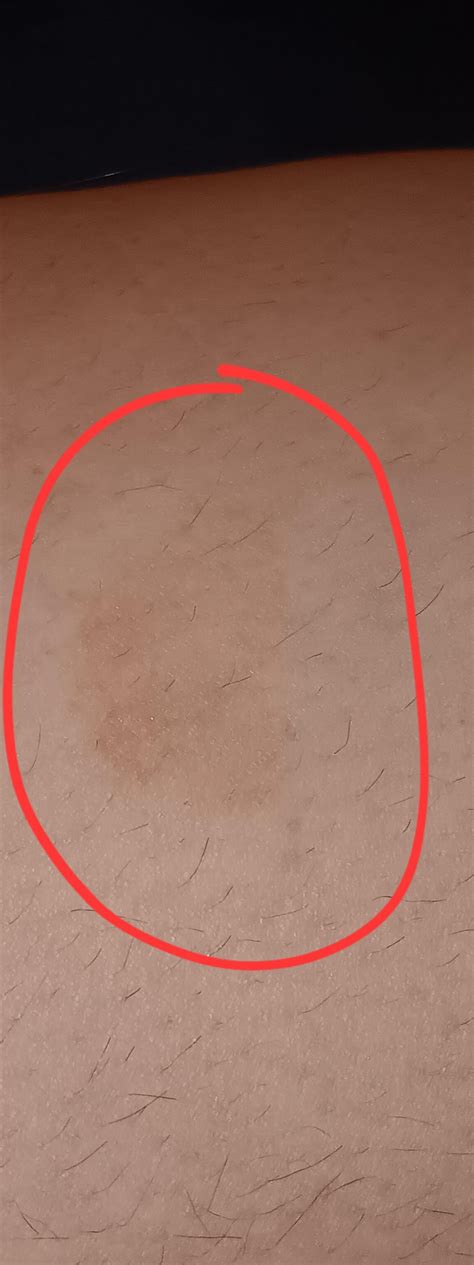 Dark spot on leg, was at first dry, was told eczema, not sure. Ringworm or tapeworm? : r/medical ...