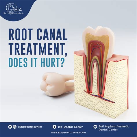 Image result for Tooth Extraction Injection