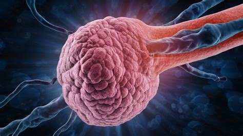 Image result for Soft Tissue Sarcoma