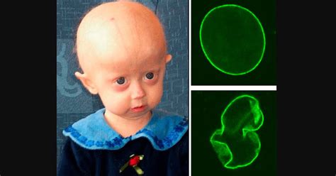 Progeria : प्रोजेरिया क्या है? जानें इसके कारण, लक्षण और उपाय- हैलो ...