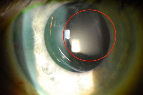 Moran CORE | Intraocular Lens (IOL) Opacification and Calcification in Patients with Hydrophilic ...