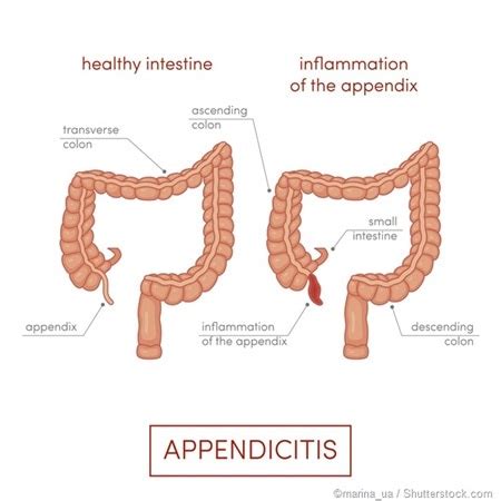 Image result for Appendix Example Website