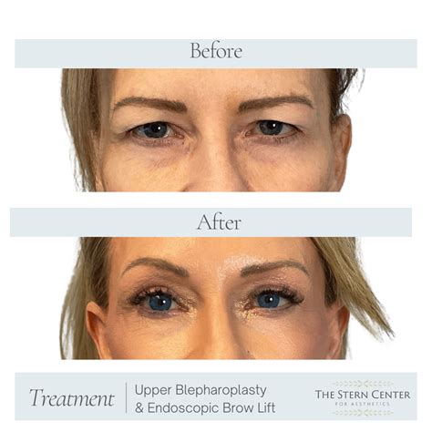 Eyebrow Lift Before And After