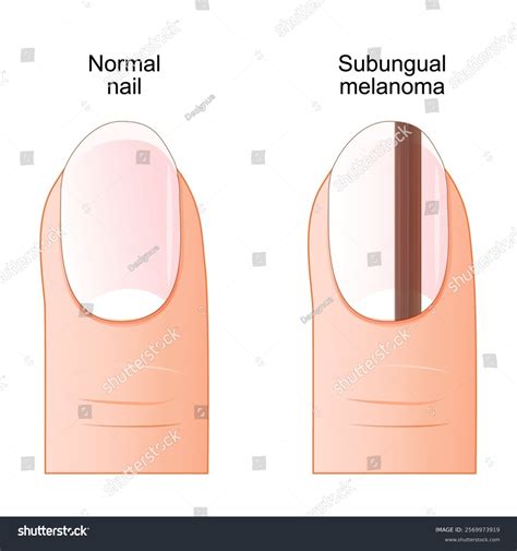 Subungual Melanoma Melanoma Under Nail Close-up Stock Vector (Royalty Free) 2569973919 ...