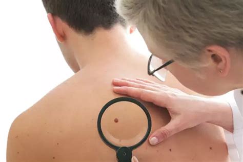 Daily aspirin may double skin cancer risk in men