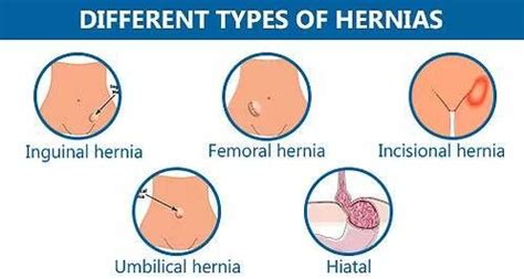 Laparoscopic "Tunnel" Approach Enhances Surgical Outcomes of hiatus ...