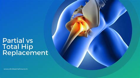 Partial Hip Replacement
