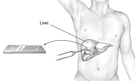 Liver biopsy procedure | Media Asset | NIDDK