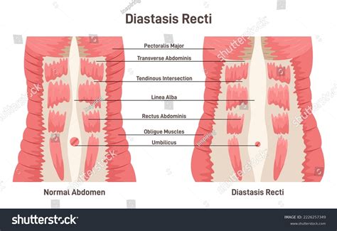 Abdominal Muscles Layers