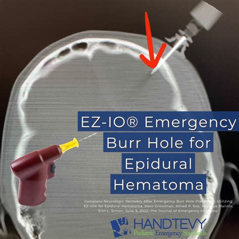 EZ-IO® Emergency Burr Hole for Epidural Hematoma - Handtevy