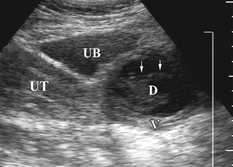 Imaging of Female Urethral Diverticulum: An Update | RadioGraphics