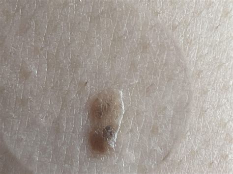 Seborrheic keratosis or possible melanoma? : r/Melanoma