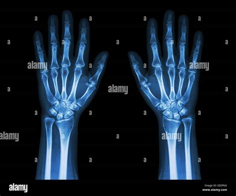 Normal Wrist X Ray PA Radiograph Of Normal Wrist | Download Scientific