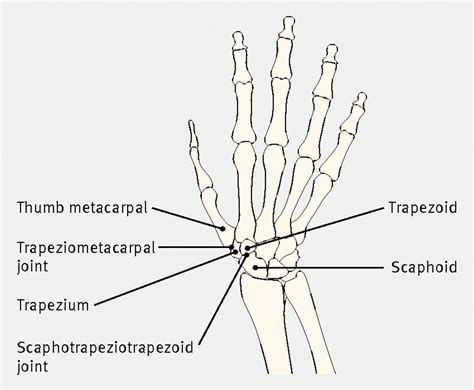 Osteoarthritis at the base of the thumb | The BMJ