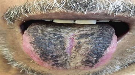 Black Hairy Tongue Images