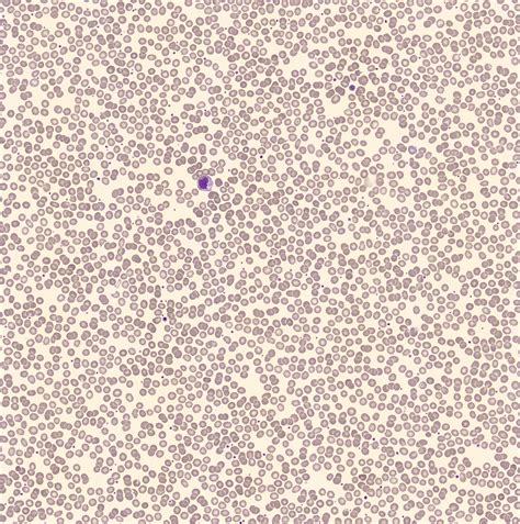 Echinocytes | CellWiki