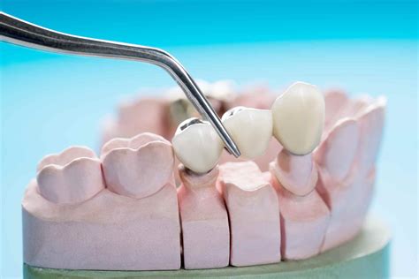 Fixed dental bridge: Understand all the details here