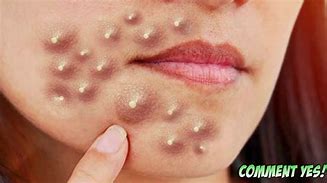 Image result for Popping Pimples Zits Blackheads