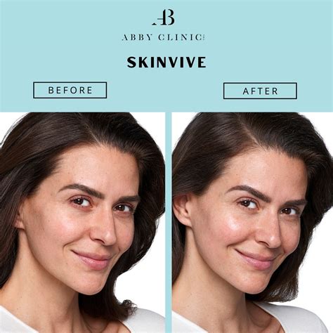 SKINVIVE by JUVÉDERM® - Dr Abby Clinic