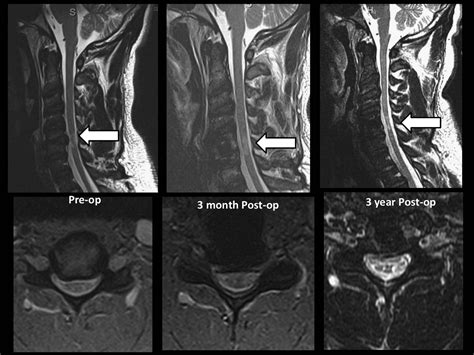 Outcomes After Anterior Cervical Discectomy and Fusion in Professional Athletes - Neurosurgery Blog - anterior cervical discectomy