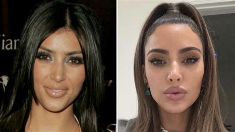 Kim Kardashian Before And After: Plastic Surgery Timeline