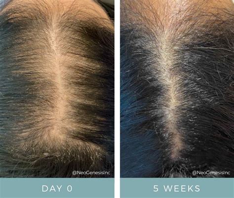 How Microneedling +NeoGenesis Can Help with Hair Loss