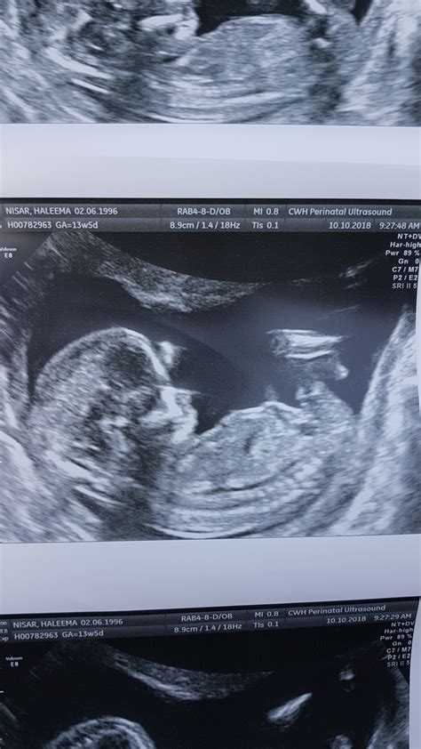 13 Week Ultrasound Pictures