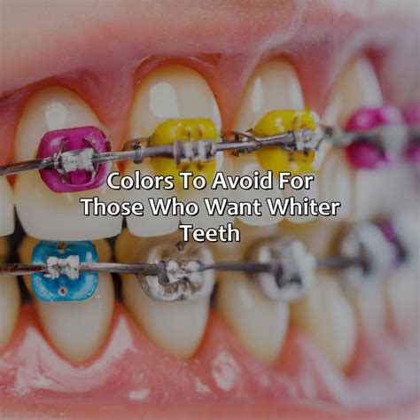 What Braces Color Makes Your Teeth Look Whiter - colorscombo.com