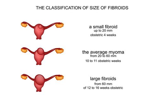 A Visual Guide To Fibroid Sizes | USA Fibroid Centers