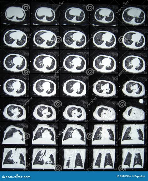 CT of thorax stock photo. Image of bronchiolitis, lung - 8582396