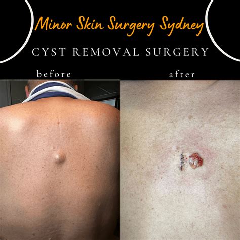 Image result for Sebaceous Cyst Removal Procedure