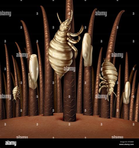 Lice on hair close up as a medical problem concept with a magnification of a human head with an ...