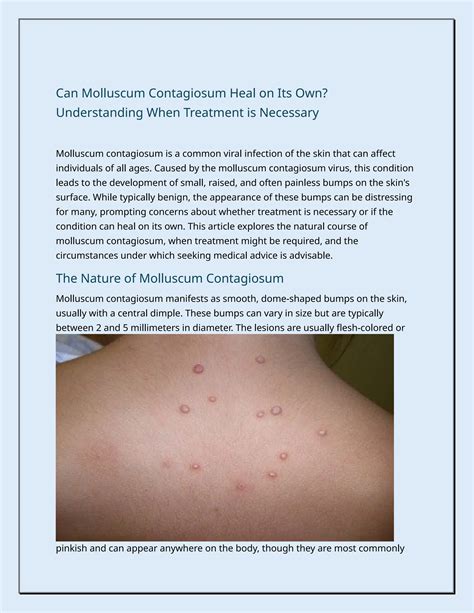 Can Molluscum Contagiosum Heal on Its Own? Understanding When Treatment ...