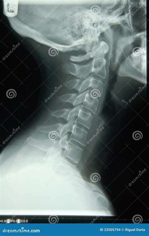 Human Neck X-ray Stock Photography | CartoonDealer.com #23505794 - neck x ray