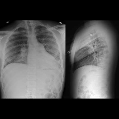 acute chest syndrome in a child with sickle cell crisis | pacs