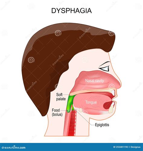 Aspiration Dysphagia