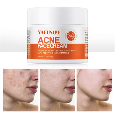 Acne Treatment Removal Cream Acne Treatment - Acne Treatment