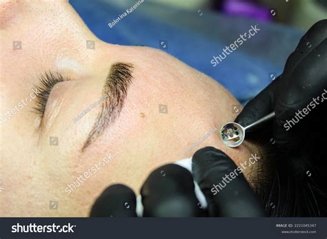 Clogged Sebaceous Glands