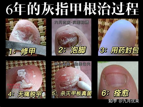 30%冰醋酸治疗灰指甲，到底会不会疼痛？疼痛的原因是什么？5步祛除灰指甲，告别真菌感染！ - 知乎