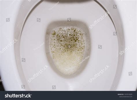 Frothy Bubbly Urine Toilet Bowl Kidney Stock Photo 1337515025 | Shutterstock