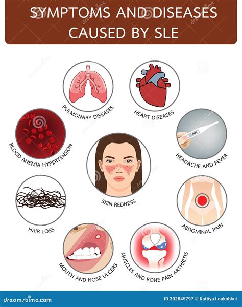 Symptoms And Diseases Caused By SLE, Infographic Illustration On White Background ...